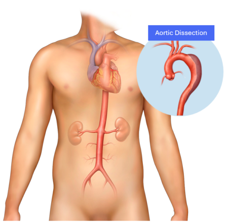 Aortic Dissection