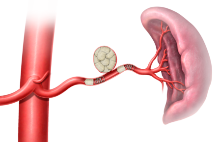 Peripheral embolization, Splenic artery and aneurysm embolization