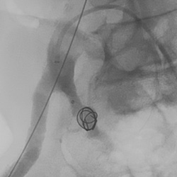 Peripheral embolization