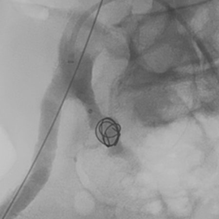 Peripheral embolization