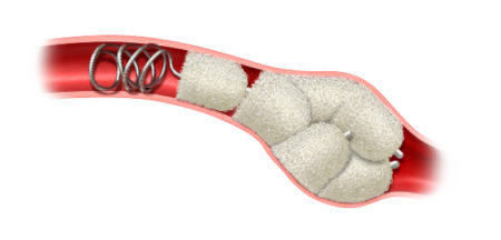 Peripheral embolization