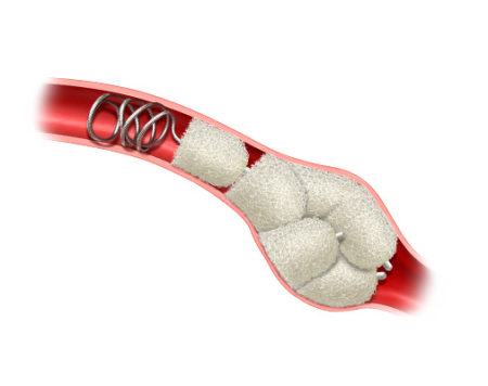 Peripheral embolization