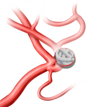 Peripheral and neurovascular embolization with Trellix