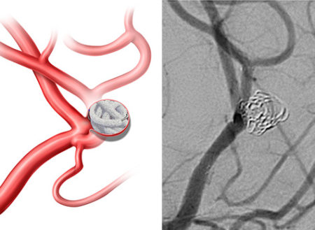 Neurovascular embolization