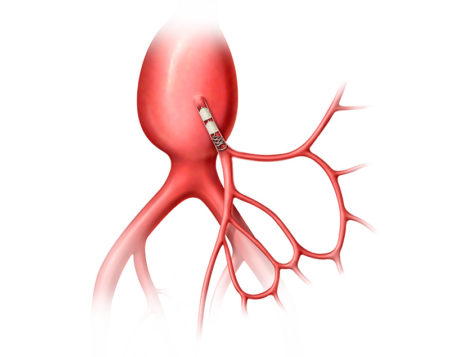 Peripheral embolization