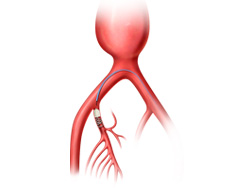 Peripheral embolization