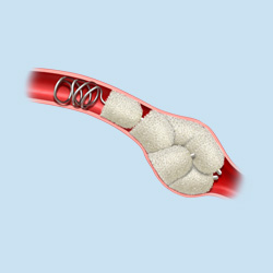 Peripheral embolization