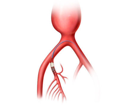 Peripheral embolization