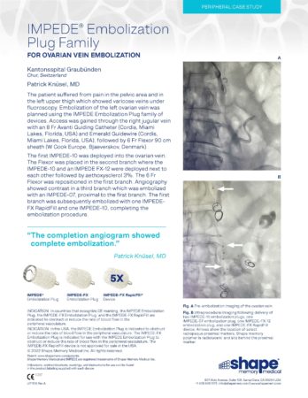 LIT1106 Rev A – Case Study – Ovarian Vein Embo – Knusel