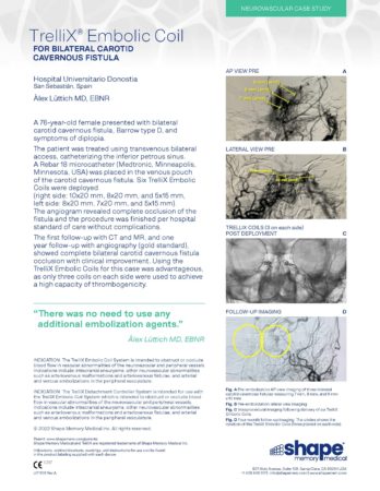LIT1108 Rev A – Case Study – TrelliX – Bilateral Carotid Cavernous Fistula – Luttich