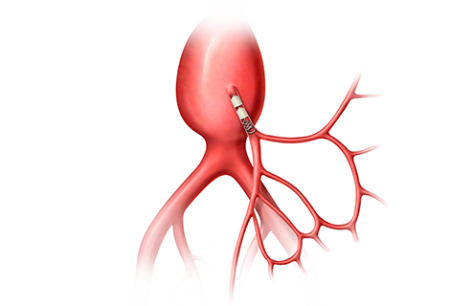 Peripheral embolization, Inferior Mesenteric Artery embolization