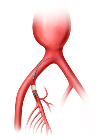 Peripheral embolization, Hypogastric artery embolization