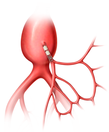 Peripheral embolization, Inferior Mesenteric Artery embolization