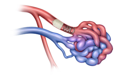 Peripheral embolization, Pulmonary arteriovenous malformation PAVM embolization