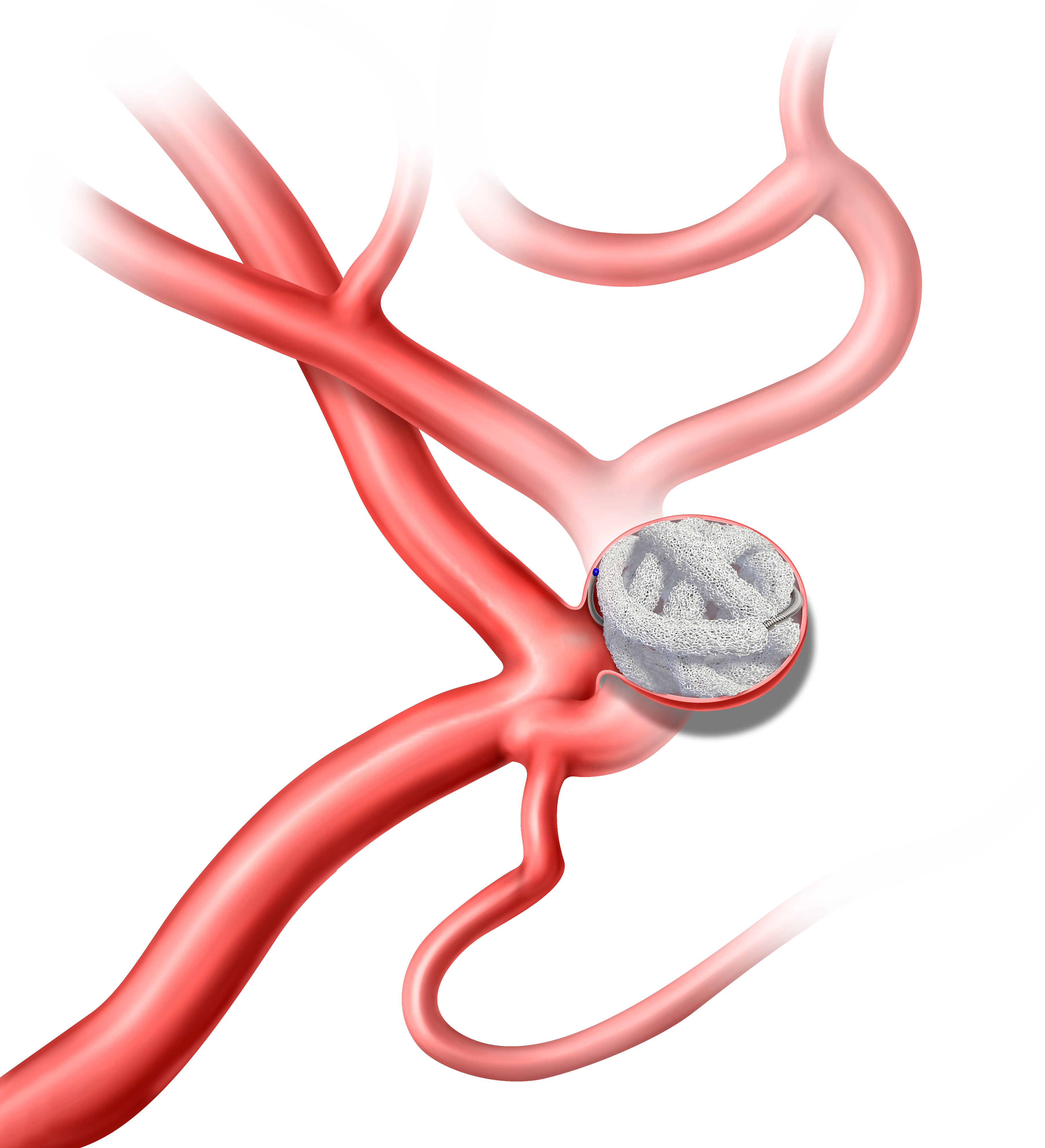 Embolization with the Trellix embolic coil