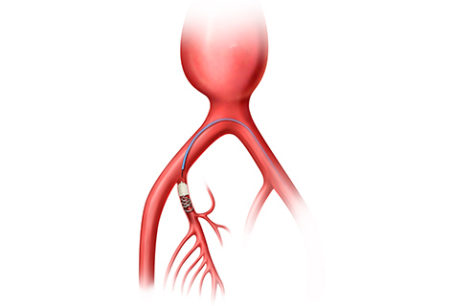 Peripheral embolization, Hypogastric artery embolization