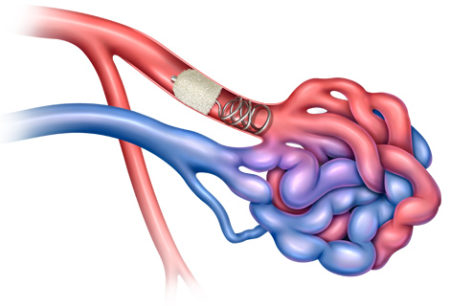 Peripheral embolization, Pulmonary arteriovenous malformation PAVM embolization