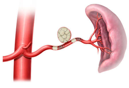 Peripheral embolization, Splenic artery and aneurysm embolization